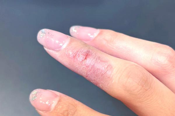 ジェルネイルアレルギーの症状と対応について。アレルギーにならないための5つの方法。